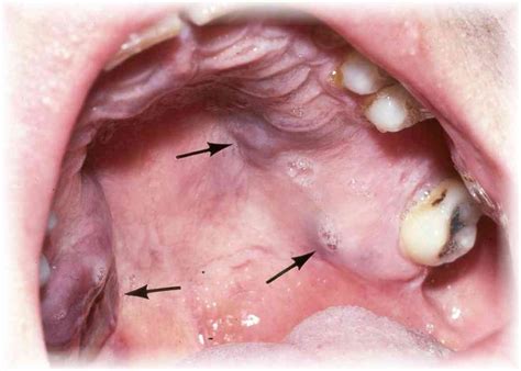 kaposi sarcoma - Google Search | Dental facts, Sarcoma, Periodontitis