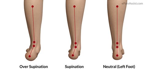 Improve The Timing Of Foot Pronation To Eliminate Plantar Fasciitis ...