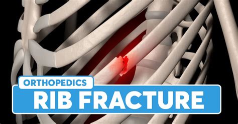 Rib Fracture: Causes, Symptoms, Risk Factors, Diagnosis, Treatment ...