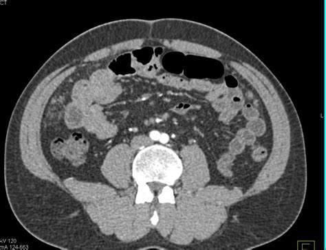 Omental Carcinomatosis - Gastrointestinal Case Studies - CTisus CT Scanning