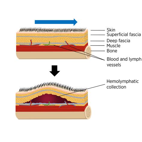 Sports Injury Bulletin - Joint Injuries - The Lesser Known Morel-Lavallée Lesion