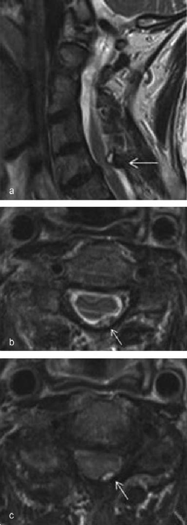 (a) Sagittal T2-weighted magnetic resonance imaging (MRI). Vertebral... | Download Scientific ...