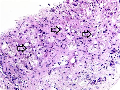 Liver Disease Histology