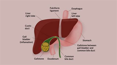 Cholecystitis – Symptoms, Causes and Complications – NutritionFact.in