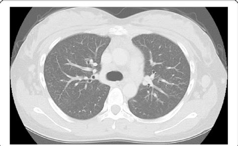 The pattern of centrilobular nodules slightly improved after the... | Download Scientific Diagram