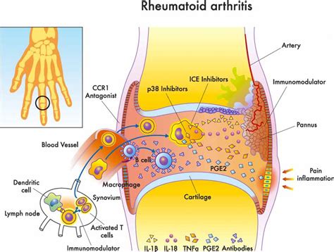 Acupuncture Alleviates Rheumatoid Arthritis Swelling And Pain