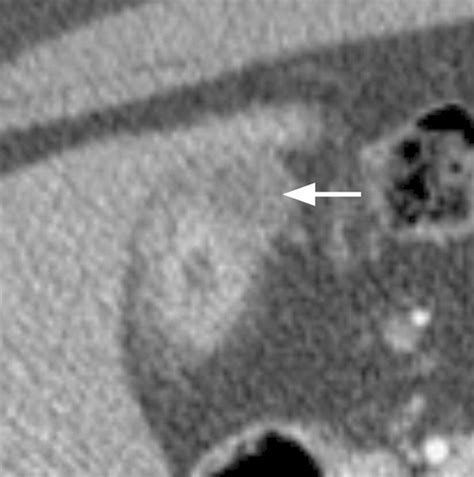 Adenomyomatosis of the Gallbladder | RadioGraphics