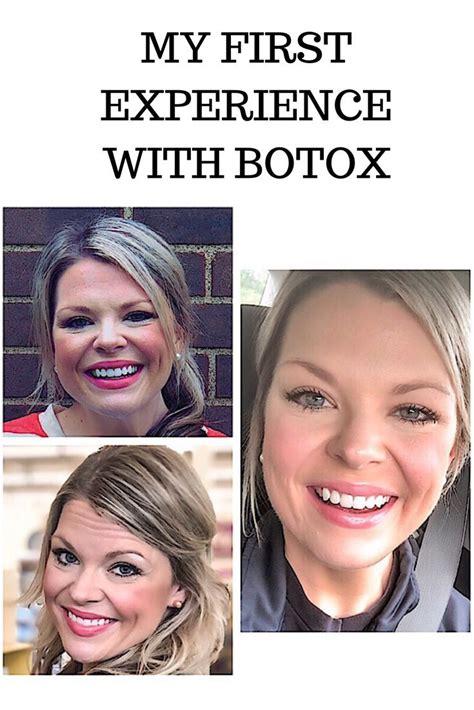 Baby Botox Before And After