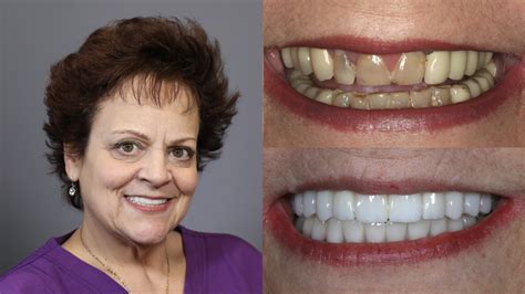 Dental Implants. Porcelain Bridges. Fixed Ti/Acrylic Hybrid 1 - Chicago Beautiful Smiles