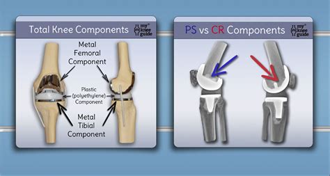 The Knee Prosthesis: The different types | Total knee replacement, Knee ...