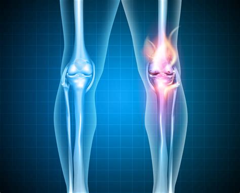 Knee Arthritis Treatment - Osteoarthritis Symptoms, Causes, Advice