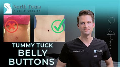 Belly Buttons | The Most Important Part of a Tummy Tuck - YouTube