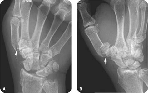 Thumb Fractures | Radiology Key