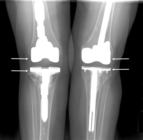 Cureus | Readmission Following Revision Total Knee Arthroplasty: An ...