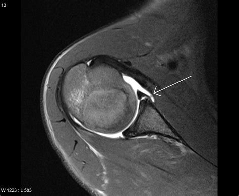 Mri Arthrogram, Glenoid Labral Tear | Musculoskletal | Pinterest | Radiology