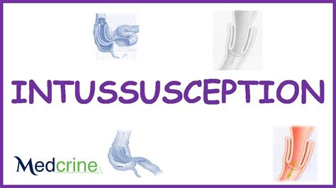 Intussusception : causes, types , pathophysiology,features,dx and treatment - YouTube