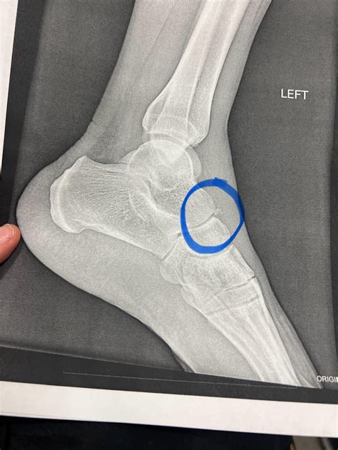 Avulsion Fracture of the Navicular : r/Radiology