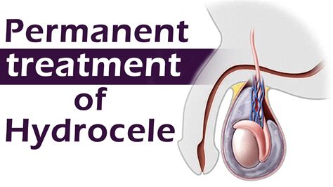 Permanent treatment of hydrocele - YouTube