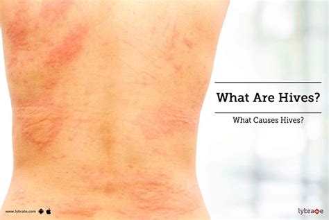 What Are Hives? What Causes Hives? - By Dr. Deepshikha Parihar | Lybrate