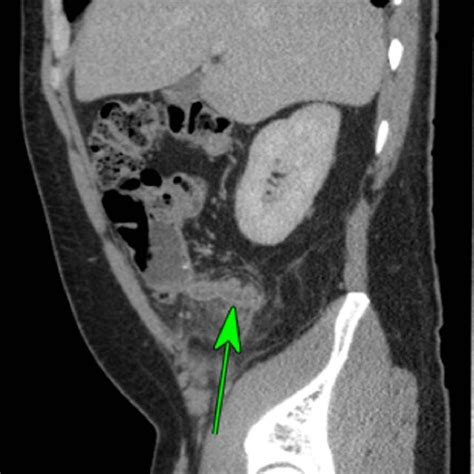 CT Scan coronal view showing thickened appendix associated with ...