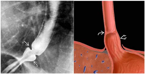 Schatzki Ring as A Cause of Dysphagia