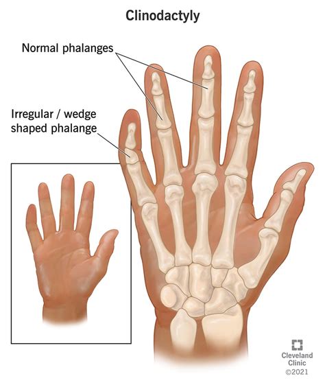 Dream interpretation,meaning of - Dreams Interpretation of Fingers ...