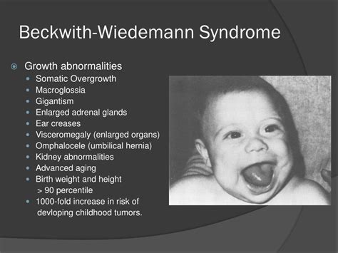 PPT - p 57 & Beckwith- Wiedemann syndrome (BWS) PowerPoint Presentation - ID:5332209