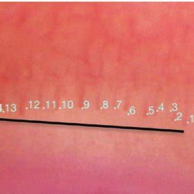 Representative photographs of nailfold capillaroscopy with 50×... | Download Scientific Diagram