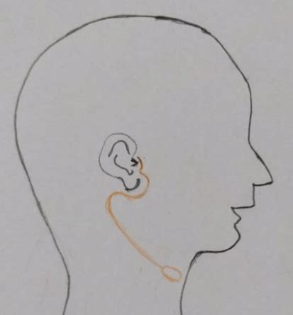 Incision with lower elliptical extension around the opening in lower... | Download Scientific ...