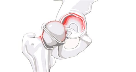 Labral Tear of the Hip Joint - Sportsinjuryclinic.net