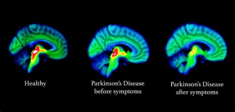 Study reveals possible early signs of Parkinson’s in the brain - Neuro ...