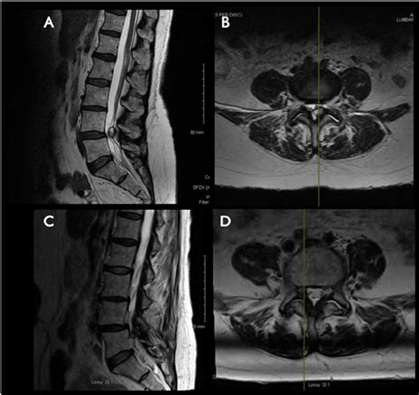 Mri Of The Lumbar Spine Demonstrating A Left L4 L5 Synovial Cyst In A | Hot Sex Picture