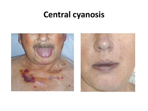 Cyanosis ppt by dr girish jain