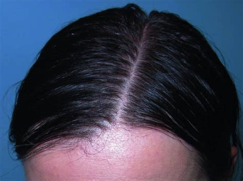 What is Telogen (telogen effluvium) hair loss? | Vinmec