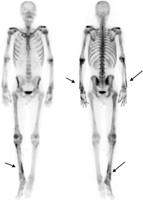 Hypertrophic Osteoarthropathy on Bone Scintigraphy | Journal of Nuclear Medicine Technology