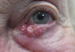 Eyelid Cancers (Malignancies) - Saul Rajak Ophthalmology