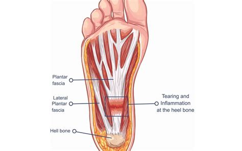 Treating Plantar Fasciitis - With a High Load Strength Training Program