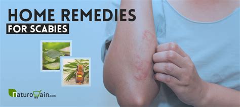 7 Best Home Remedies for Scabies to Prevent Skin Rashes