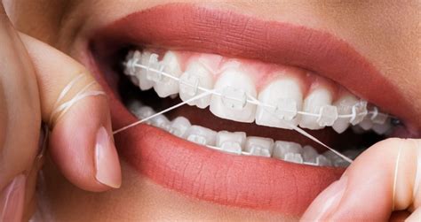 Flossing with Braces – How to Floss When you Have Braces | The ...