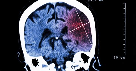 Ask the Pharmacist: Gadolinium MRI contrast dye accumulates in brain