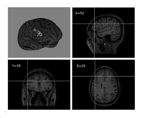 | Right dorsolateral prefrontal cortex (DLPFC) TMS target visualized ...