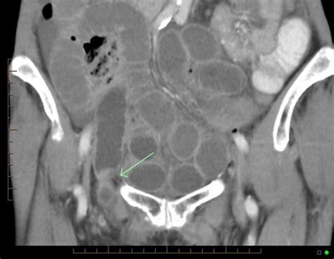 Femoral Hernia