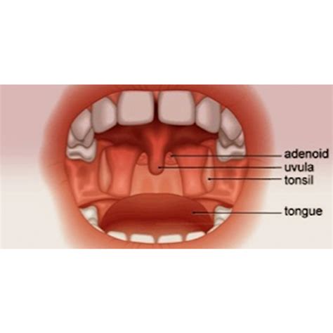 What Are Tonsils And Adenoids Sore Throat Pain In Children Tonsils | Images and Photos finder