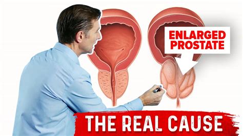 Enlarged Prostate and Urination Problems Explained