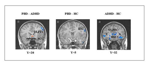 Adhd Brain Vs Normal Brain Mri : Orphanage Care Linked To Thinner Brain Tissue In Regions ...