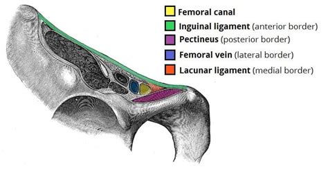 Femoral Hernia - Risk Factors - Clinical Features - Management ...