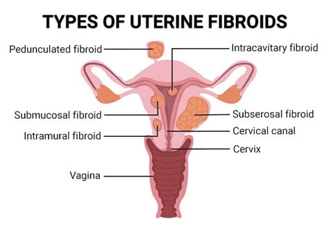 Uterine Fibroids Types