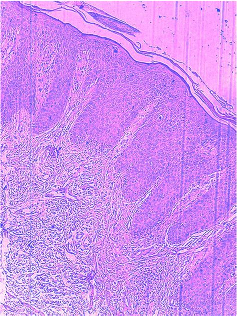 Chronic eczema. Histologic features: discreet spongiosis with... | Download Scientific Diagram