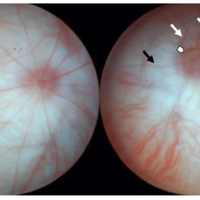 Representative fundus images. (A) ND (right eye); (B) DM (right eye).... | Download Scientific ...