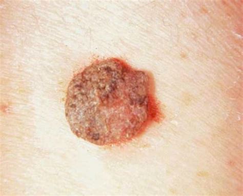 Seborrheic Keratosis - Pictures, Symptoms, Treatment, Removal and ...